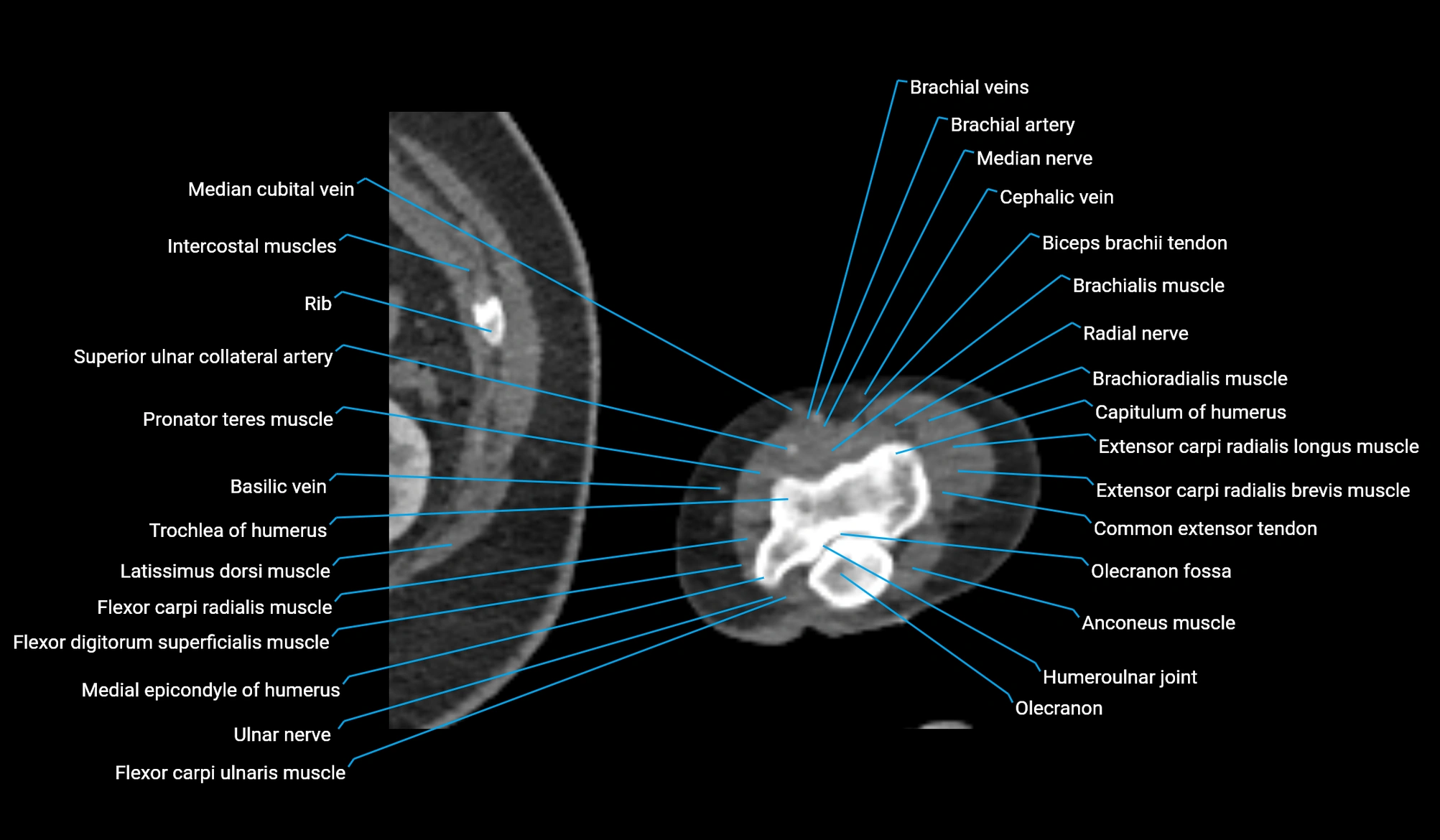 CT upper arm axial  cross sectional anatomy labelled radiology image -00388.webp